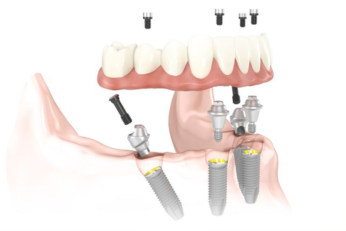 All-on-4 dental implants diagram - four implants supporting a full arch