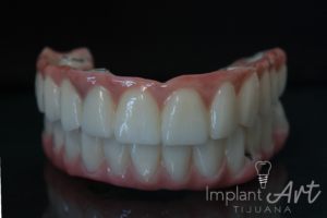 Case 3 · Full mouth – All-on-4 treatment photo 4