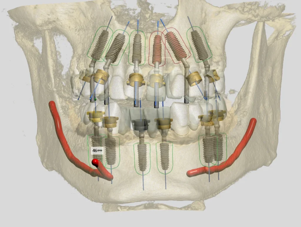 3D All-on-4 implant plan in the lower jaw, front view