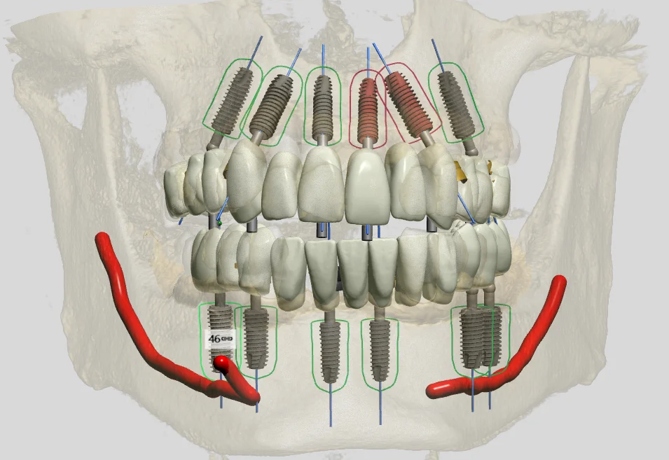 3D digital plan of full-arch implants with teeth in place