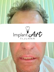 Case 1 · Full mouth – All-on-4 treatment photo 3