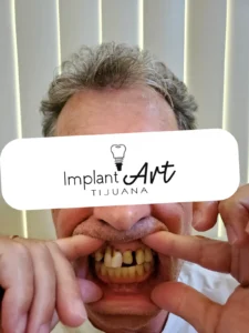 Case 1 · Full mouth – All-on-4 treatment photo 1
