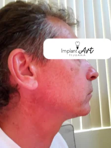 Case 1 · Full mouth – All-on-4 treatment photo 2