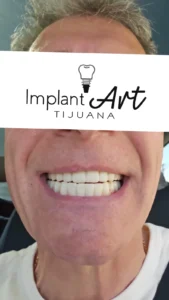 Case 1 · Full mouth – All-on-4 treatment photo 8