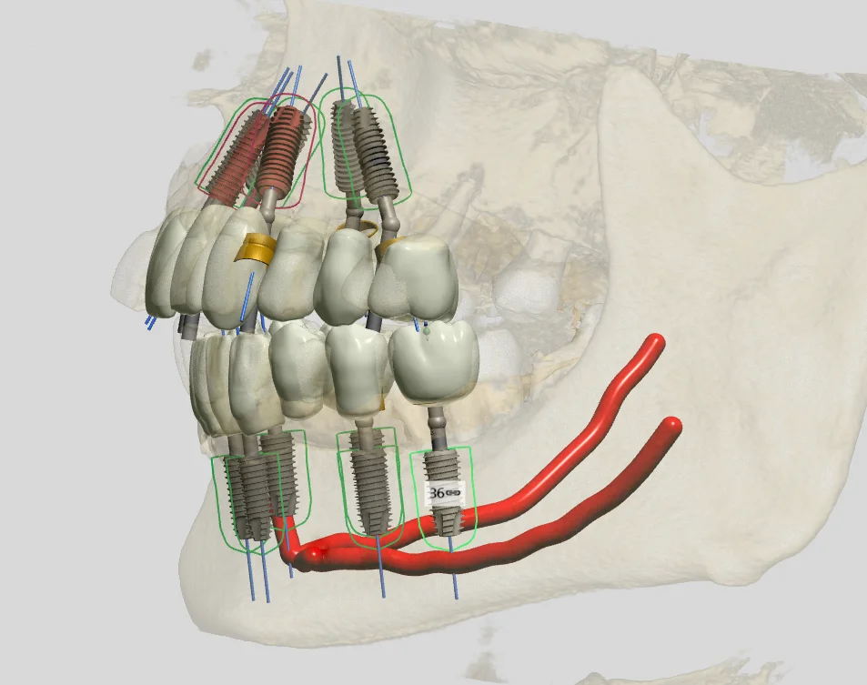 3D All-on-4 implant plan, side view of the jaw