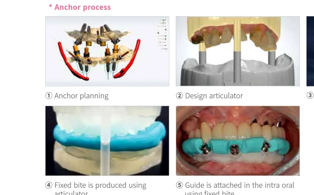 Full-arch guide planning, articulator and bite index