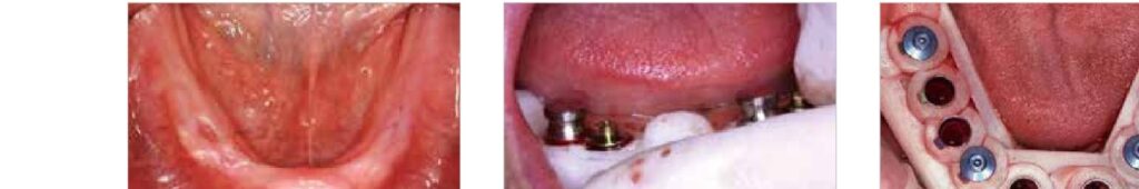 Full-arch surgical guide fixed in the mouth with pins