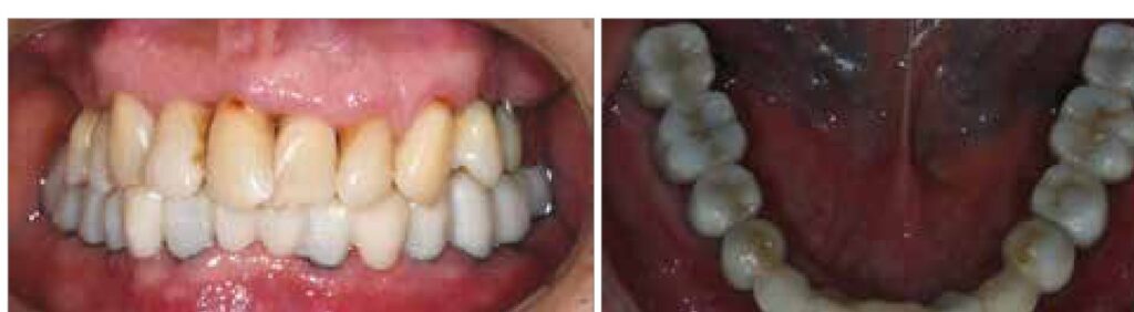 Full-arch result after guided implant surgery
