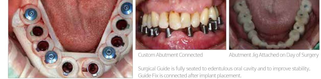 Guided full-arch implant surgery steps