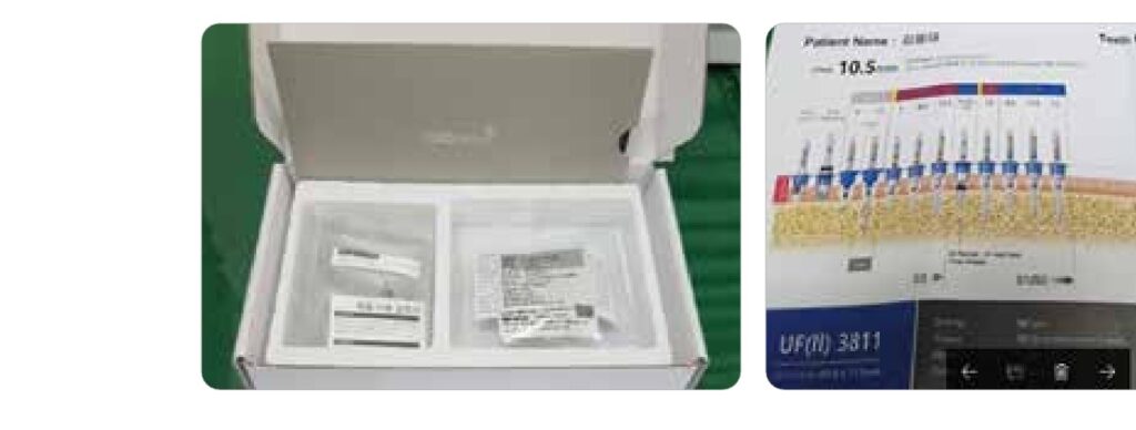Surgical guide package and drilling protocol