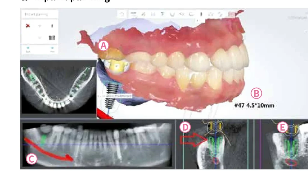 3D Digital All-on-4 implant planning on CT and scan data