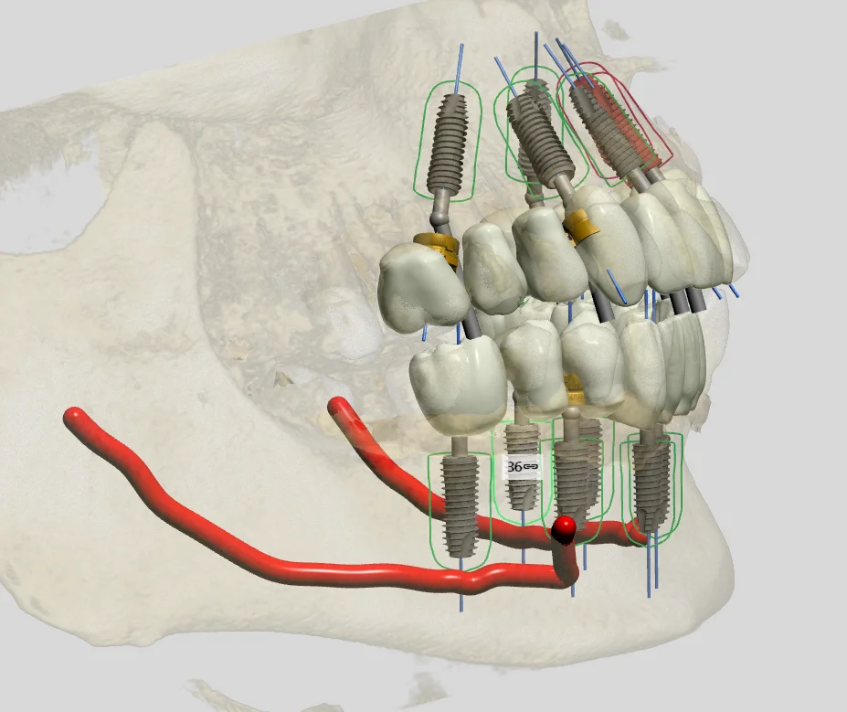 3D All-on-4 implant plan avoiding the nerve, angled view