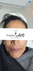 Case 2 · Full mouth – All-on-4 treatment photo 5