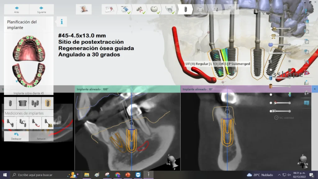 Implant position planned on CBCT cross-sections