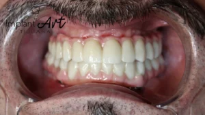 Case 3 · Full mouth – All-on-4 treatment photo 2