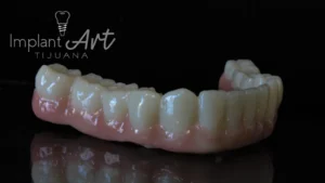 Case 3 · Full mouth – All-on-4 treatment photo 7