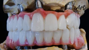 Case 3 · Full mouth – All-on-4 treatment photo 3