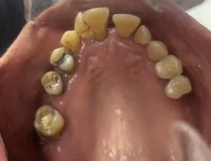 Case 1 · Full mouth – All-on-4 treatment photo 4