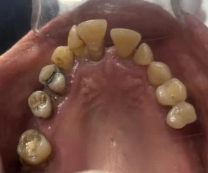 Case 1 · Full mouth – All-on-4 treatment photo 5