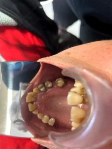 Case 1 · Full mouth – All-on-4 treatment photo 6