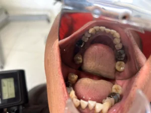 Case 1 · Full mouth – All-on-4 treatment photo 7