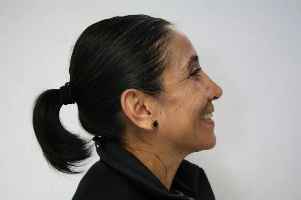 All-on-4 patient smiling after treatment, profile view