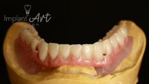 Case 3 · Full mouth – All-on-4 treatment photo 5