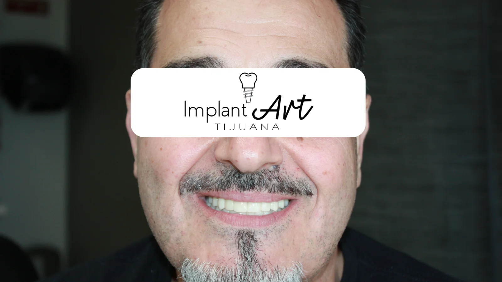 All-on-4 case - after treatment at Dental Implant Art Tijuana