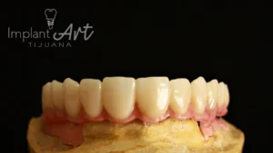 Case 3 · Full mouth – All-on-4 treatment photo 6