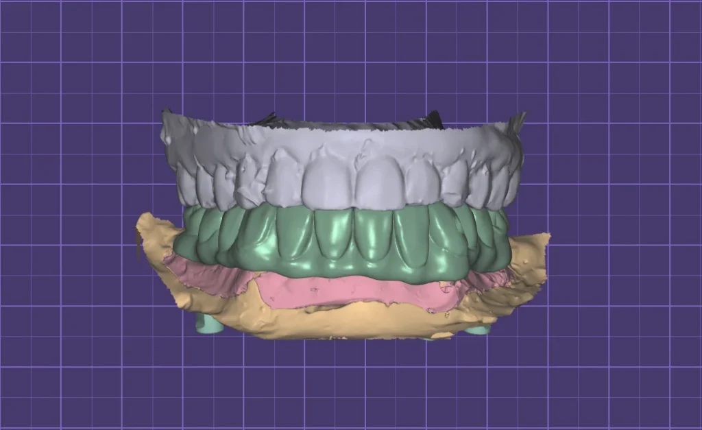 Upper and lower full-arch bridges designed digitally