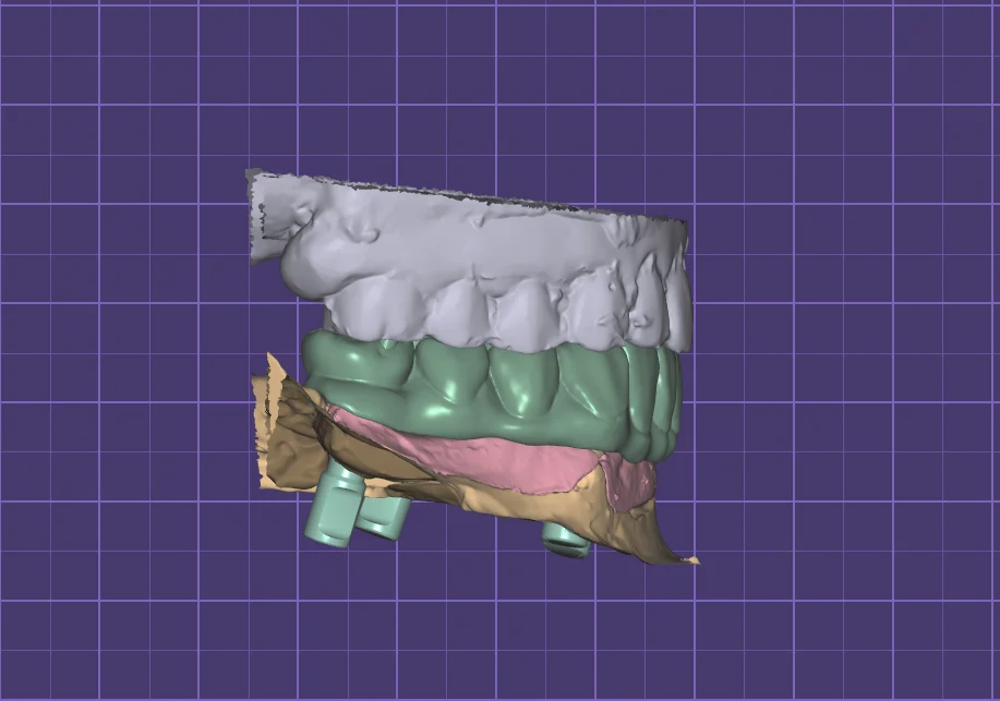 Bite check of a digitally designed full-arch bridge