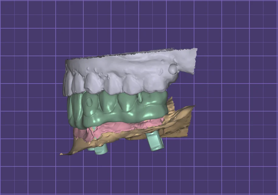 3D design of a full-arch implant bridge