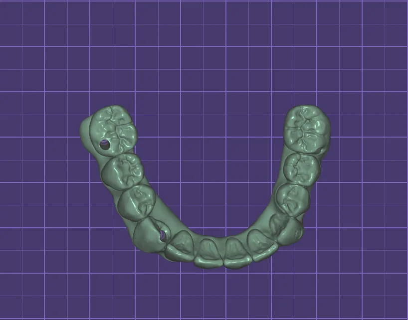 Full arch designed on implants