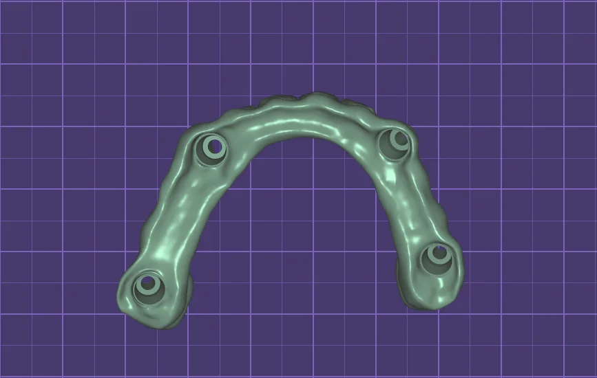 CAD/CAM design of an All-on-4 bridge