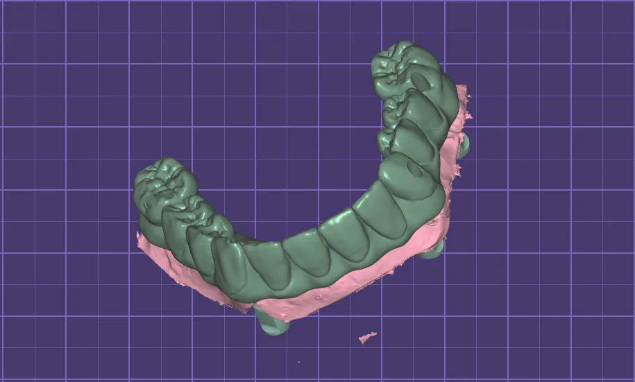 Lower arch All-on-4 bridge design