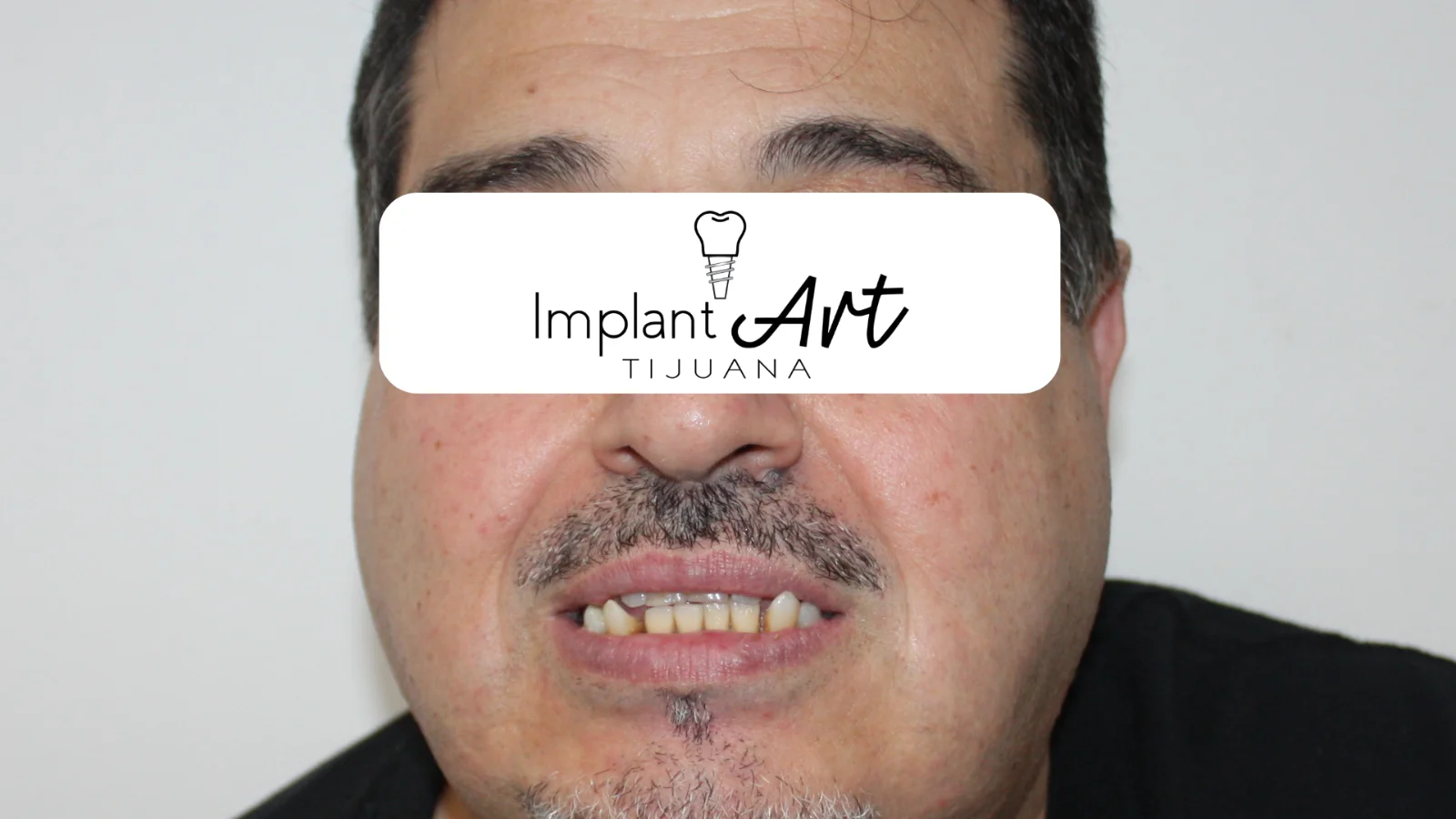 All-on-4 case - before treatment at Dental Implant Art Tijuana