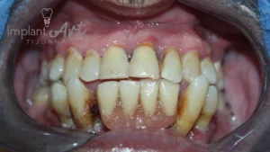 Case 3 · Full mouth – All-on-4 treatment photo 1