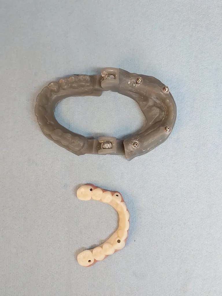 Finished full-arch bridge ready for the patient