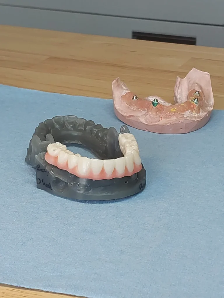 3D printed dental model