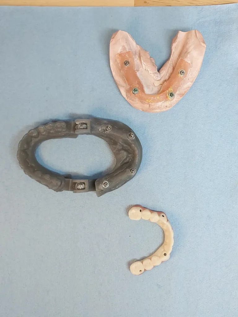 Prototype teeth ready for try-in