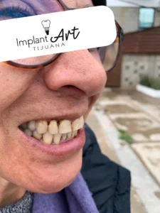 Case 2 · Full mouth – All-on-4 treatment photo 1