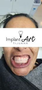 Case 2 · Full mouth – All-on-4 treatment photo 6