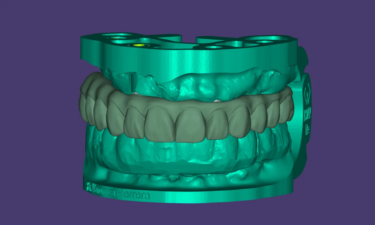 3D digital design of an All-on-4 upper bridge on four implants