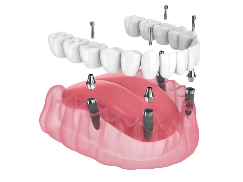 All-on-4 illustration: full-arch bridge screwed onto four dental implants