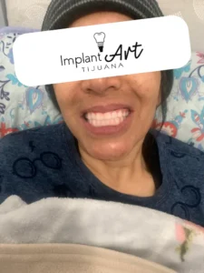 Case 2 · Full mouth – All-on-4 treatment photo 4