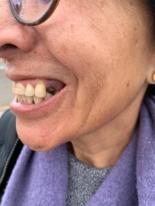 Case 2 · Full mouth – All-on-4 treatment photo 2