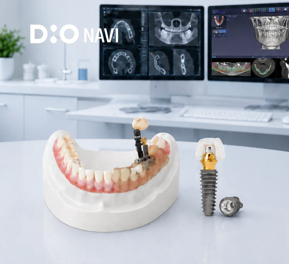 3D Digital Full Arch digital guide with implants