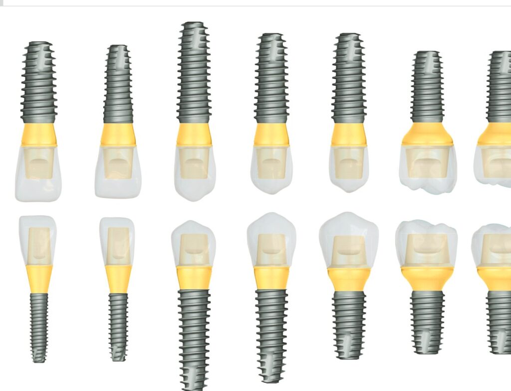 DIO UF II implant sizes for each tooth