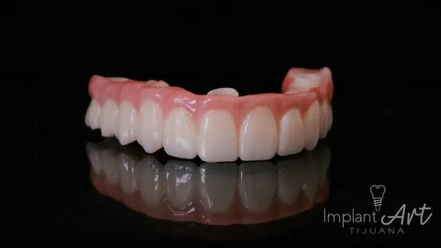 Full-arch bridge on implants made in our dental lab