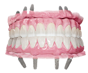 Fixed full-arch teeth on four implants